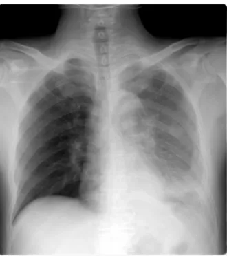 Figure  1.  Chest  PA  shows  the  left  lung  mass  lesion  with  large  amount  of  pleural  effusion.