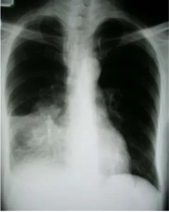 Figure  4.   On  twenty  days  after  admission,  chest  radio-  graphy  demonstrating  improved  right  middle  lobe  in-  filtrates