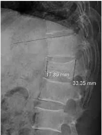 Fig. 2. Final simple x-ray lateral view. Kyphotic angle increas- increas-es to 25.4° , and wedge compression ratio decresese to 0.37.