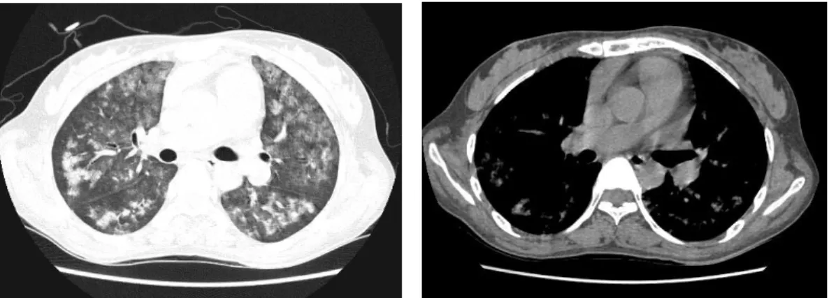 Fig. 3. HRCT  shows  bilateral,  widespread,  patchy,  ill-defined  densities  with  normal  lung  architectures  without  any  pleural  effusion.
