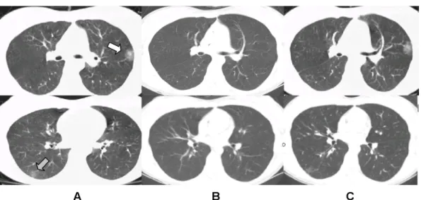 Fig. 1. A. Chest CT scan obtained during the patient's menstrual period shows ground glass opacities at anterior segment of the left upper lobe (white arrow) and superior segment of the left lower lobe (gray arrow)