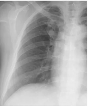 Fig. 1. Magnified  chest  radiograph  of  the  right  lung  shows  a  pulmonary  nodule  in  the  right  upper  lobe