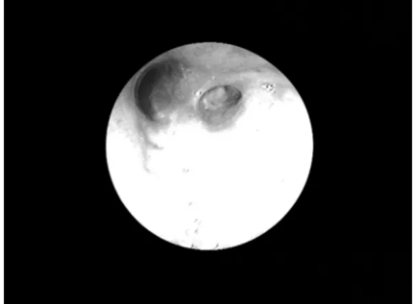 Fig 3. Fiberoptic  bronchoscopy  of  the  right  upper  lobar  bronchus  confirms  the  obliteration  of  the  apical  segmental  bronchus,  which  was  seen  on  Fig  2f