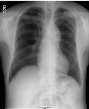 Fig. 1. Chest  radiograph  showed  a  stent  in  the  aortic  arch  and  no  specific  abnormal  findings  on  lung  parenchyma.
