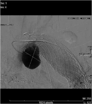 Fig. 4. Aortogram  showed  about  3cm  sized  sac 
