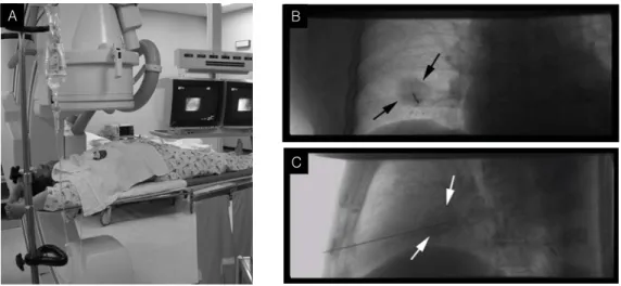 Fig. 2. Fluoroscopy-guided  transthoracic  needle  biopsy  for  a  hamartoma.