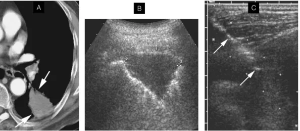 Fig. 3. Ultrasonography-guided  transthoracic  needle  biopsy.