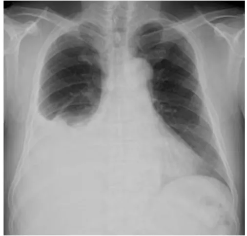 Fig. 1. Chest  X-ray  of  60-year-old  man  with  right  pleural  effusion.