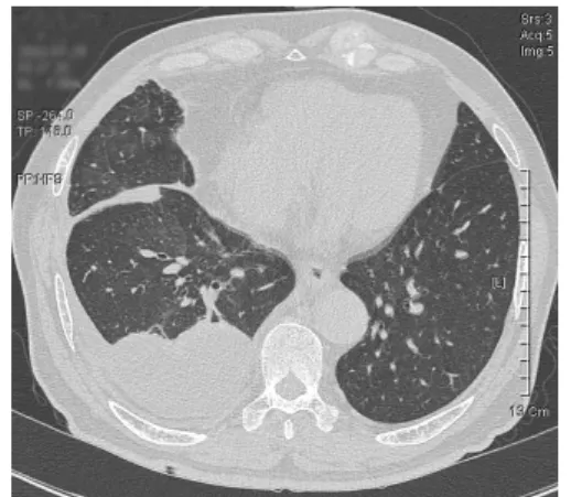 Fig. 4. Chest  X-ray  shows  decreased  pulmonary  edema  compared  with  previous  films  on  5days  after  thoracentesis  with  natural  drainage.