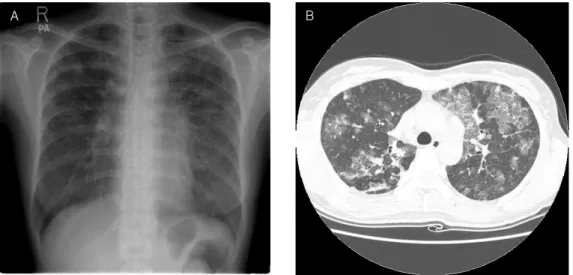Fig. 1. A. Chest  X-ray  shows  extensive  patchy  areas  of  ground-glass  opacities  with  increased  interstitial  markings  in  both  lung  fields.