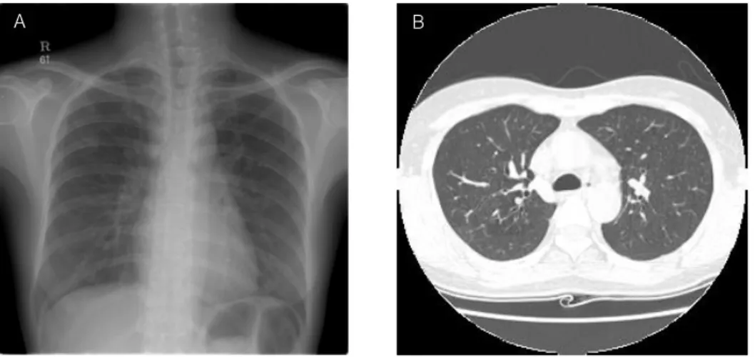 Fig. 4. A. Marked  interval  improvement  of  interstitial  lung  markings  is  seen  two  days  later  with  steroid  therapy.