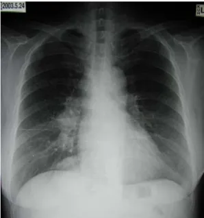 Fig. 1. Chest  PA  of  the  patient  on  admission: 