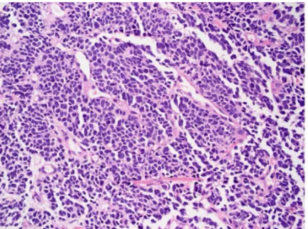 Fig. 5. The  sonoguided  biospy  of  the  left  breast  mass  shows  small  cell  carcinoma,  con 