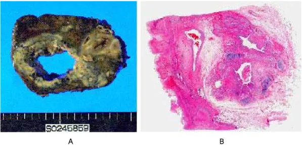 Fig. 2. A.  Right  lower  lobectomy  specimen  shows  large  cavity  and  several  granulomas  with  caseating  materials