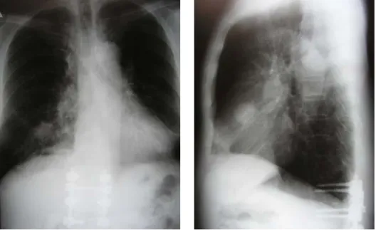 Fig. 1.  Chest  radiograph  shows  a  mass  in  the  right  middle  lobe. 서  가장  많이  발생하고,  결막,  폐,  유방,  신장,  침 샘,  갑상샘,  소장,  대장,  피부,  간,  방광  등  신체  거 의  모든  장기에서  발생한다고  알려져  있다 3 