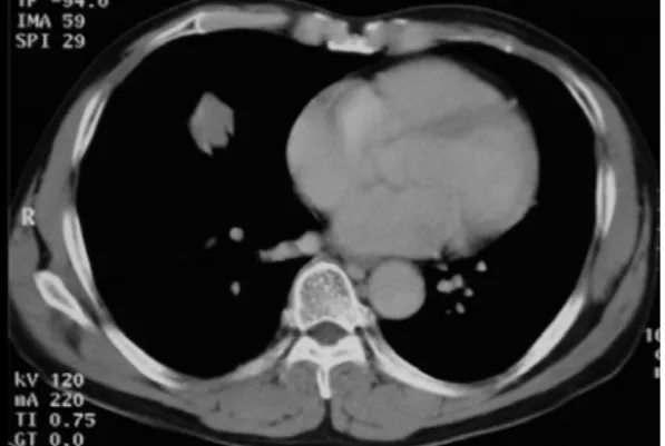 Fig. 2. Chest  CT  scan  shows  a  3×2-cm  mass  with  air-bronchogram  in  the  right  middle  lobe.