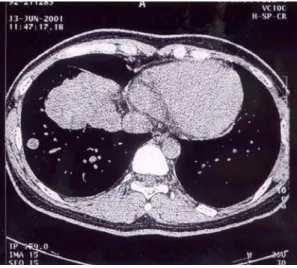 Fig. 1. 5cm  sized  round  mass  protruding  from  the  right  diaphragm.