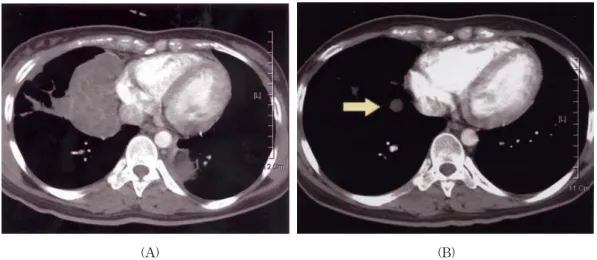 Fig. 4.  A.. Chest  CT  scan(at  2  weeks  after  excisional  biopsy)  :  Rapid  aggravation  of  the  remnant  tumor  at  RML  and  a  left  lower  paraspinal  area  occurred