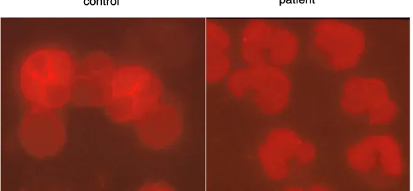 Fig. 3. NF-κB  was  activated  in  the  basal  state  neutrophils  of  sepsis  patients
