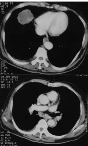 Fig. 2. Chest  CT  shows  a  lobulated,  heterogene 