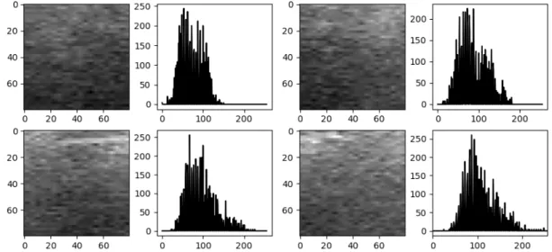 Figure 6 shows a sample and histogram of an ROI image obtained at an arbitrary location in the ultrasound  image  (%IMF  =  13.47%)  shown  in  Figure  2