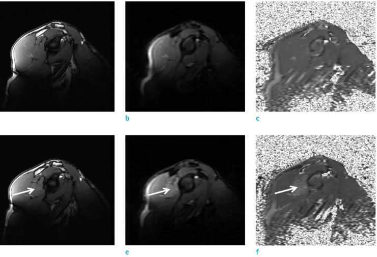 Figure 4 shows representative MR images of the right  shoulder after 10 sets of exercise
