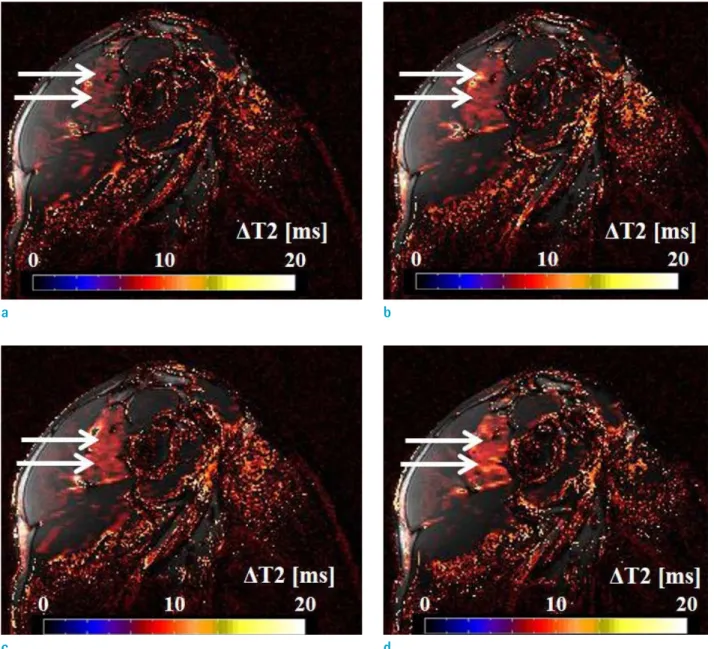 Fig. 5.  Fused image using fast-mfMRI obtained after 2 sets ( a ), 4 sets ( b ), 6 sets ( c ), and 8 sets ( d ) of exercise