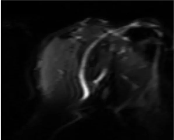Fig. 6.  T2-weighted MR image of a rotator cuff by SSSE-