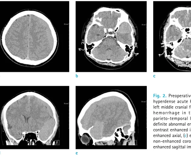 Fig. 2.  Preoperative brain CT shows  hyperdense acute hematoma in the  left middle cranial fossa and subdural  hemorrhage in the left  fronto-parieto-temporal lobe