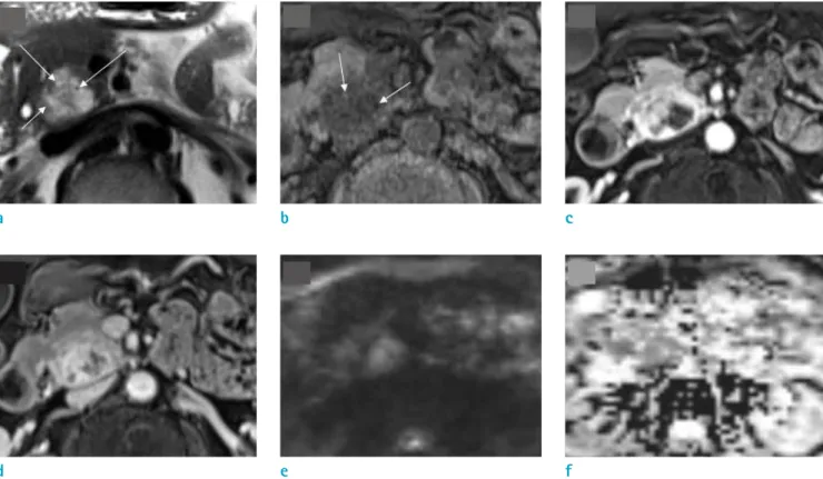 Fig. 2.  MRI of the patient. On MRI, the main solid portion of the lesion shows mild high SI on T2WI image and mild  low SI on T1WI image