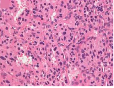 Fig. 4.  Gross pathological examination ( a ) revealed a well-circumscribed pink tanned rubbery soft tissue mass (arrows)  surrounded by the normal pancreatic parenchyma with foci of inner hemorrhage, which was consistent with the image  findings