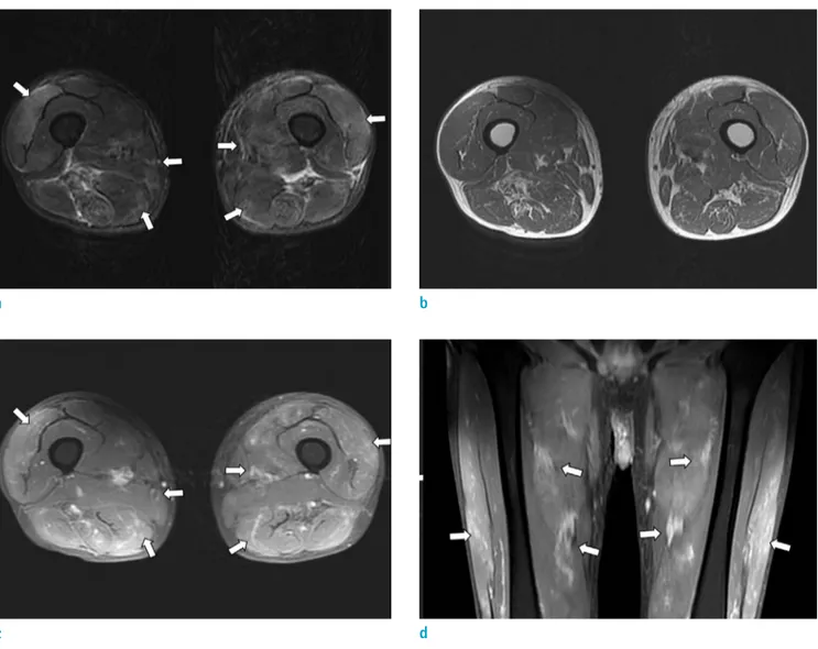 Fig. 1.  Axial image of T2-weighted fat-saturated magnetic resonance imaging ( a ) shows multifocal patchy T2 high-signal  intensity foci in the intramuscular area of both thighs involving the vastus and adductor muscle groups, rectus femoris,  and semiten