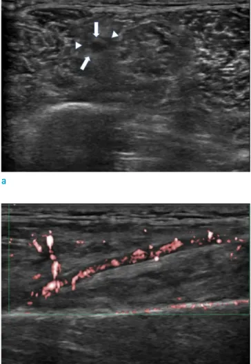 Fig. 3.  Incisional biopsy was performed on the left gastrocnemius muscle. Microscopic features ( a ) show small- and  medium-sized arteries in the intramuscular tissue (left image, hematoxylin and eosin stain, × 100 magnification)