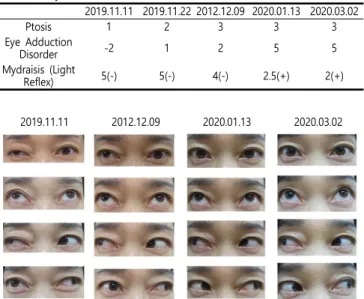 Table  1.  Subjective  Symptom  Evaluation  Index Symptom  severity Diplopia 0  (none)  ~  10  (Severe)Vertigo Periocular  Pain