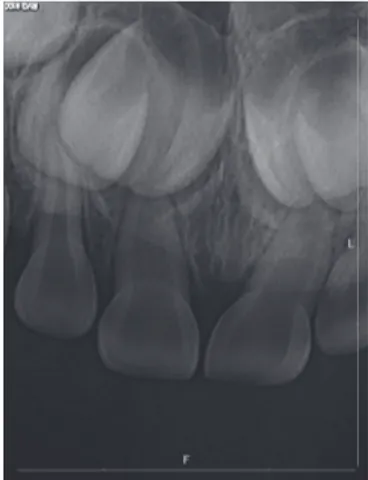 Fig. 1. Intraoral view showing the swelling of the inner mu-