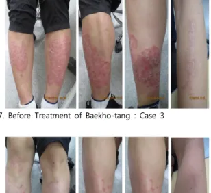 Fig.  8.  After  Treatment  of  Baekho-tang  :  Case  3