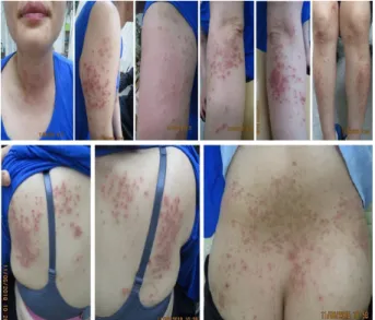 Fig.  1.  Before  the  Baekho-tang  Treatment  :  Case  1.
