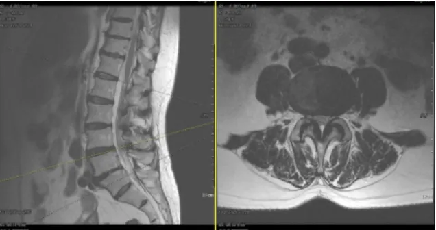 Fig.  3.  T2  weighted  sagittal  and  axial  view  of  Case  2,  권○○,  Level  L4-L5.