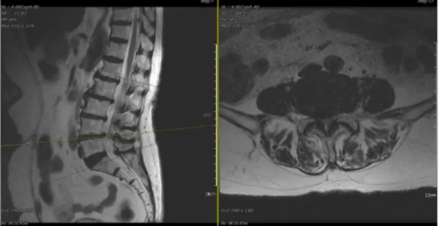 Fig.  7.  T2  weighted  sagittal  and  axial  view  of  Case  4,  선○○,  Level  L4-L5. 7)  한의학적  진단          舌紅無苔  尺脈浮大,  數脈 8)  치료경과         2016년  09월  26일,  NRS  10,  ODI  60.00의  통증  강도로  입원 하였다