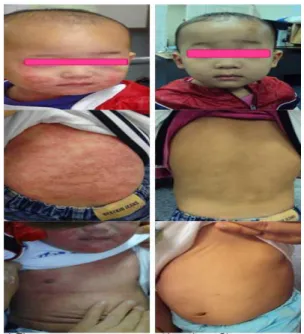 Fig.  1.  Progress  of  atopic  dermatitis  :  Case  1 