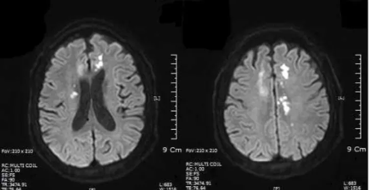 Fig.  2.  Brain  MRI  :  diffusion  weighted  image,  coronal  view.