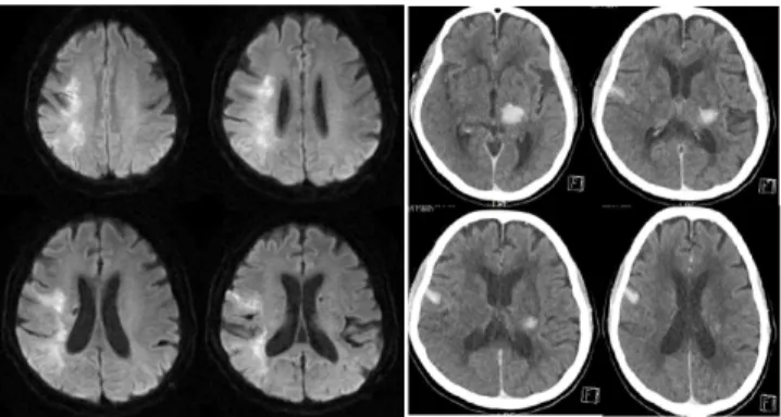 Fig.  1.  Magnetic  Resonance  Imaging  (Diffusion  weighted  imaging),  Brain  Computed  Tomography