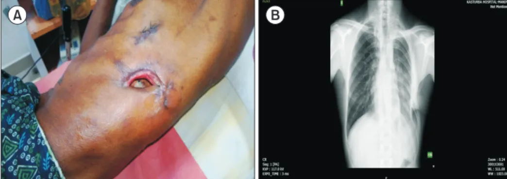 Fig. 3. (A) Postoperative follow­up  after 1 month, showing a well­