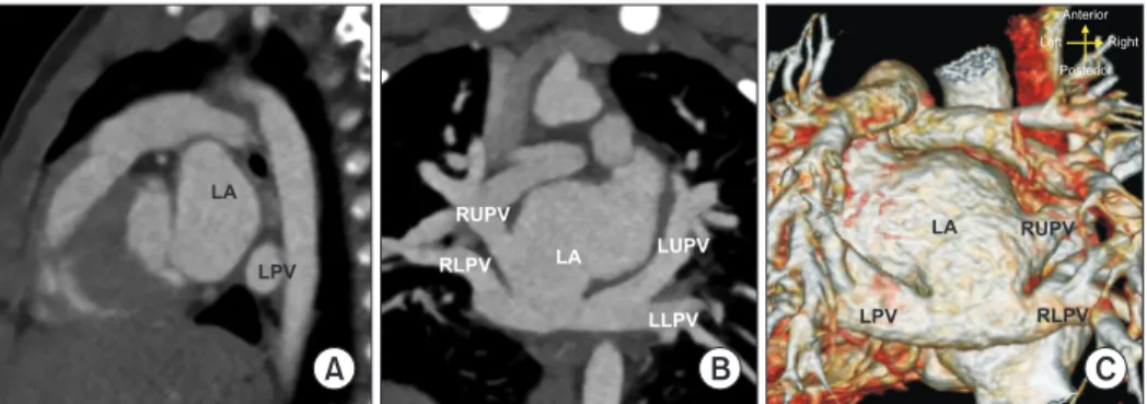 Fig. 2. One­year follow­up computed tomography scan. (A) No residual membranous structures were identified in the left atrial cham­