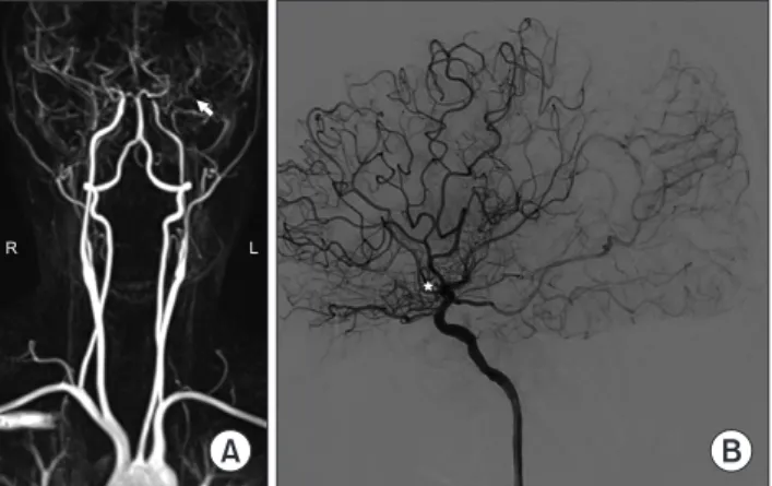Fig. 1. Preoperative brain magnetic resonance angiography and  transfemoral cerebral angiography