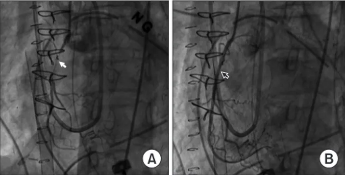 Fig. 2. Preoperative coronary angiography of unstable angina with  2­vessel disease. (A) Chronic total occlusive lesion in the left anteri­