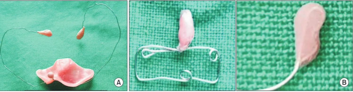 Fig. 1. Photograph of intraoral (A) and extraoral (B) nasoalveolar molding (NAM) appliances.