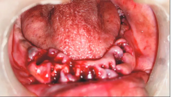 Fig. 3. Dehydrated human amniotic/chorionic placed after alveo- alveo-loplasty procedure.