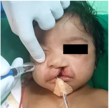 Fig. 1.  Infraorbital block being given