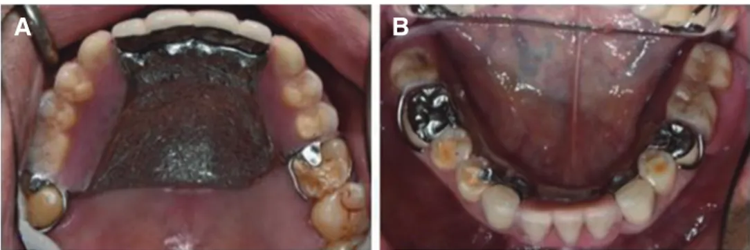 Fig. 17. Restoration of final denture in case 3. (A) Maxilla, (B) Mandible. Kennedy class III case in maxillary restoration 